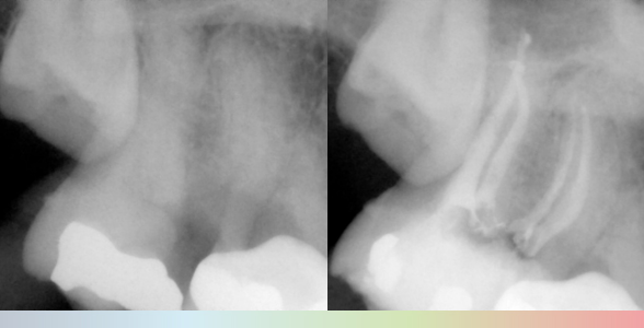 Clinical Case: endodontic treatment with BlueShaper PRO® by Dr. Juan Algar 