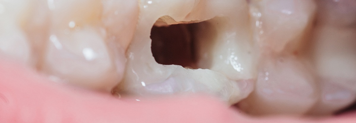 Los 3 Tipos de Cemento Dental: Los Mejores Cementos - IPG Dental