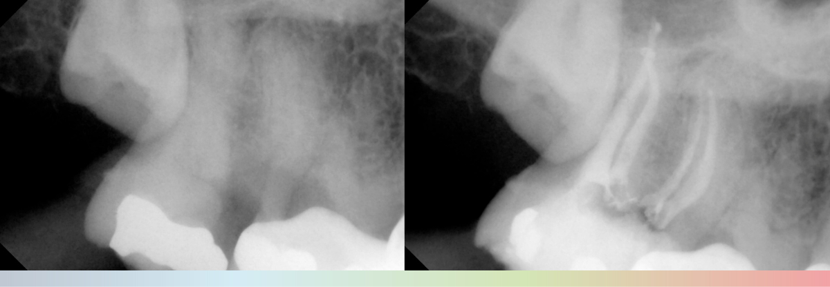 Clinical Case: endodontic treatment with BlueShaper PRO® by Dr. Juan Algar 